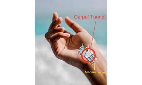 Carpal Tunnel: What You Need to Know
